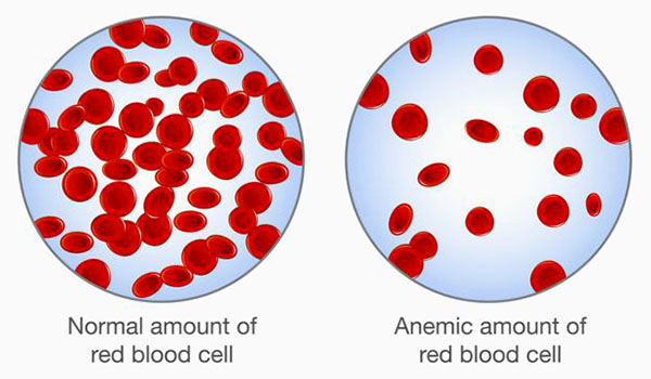 Anemia blood count