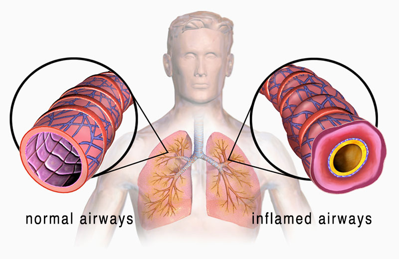 Normal vs inflamed airways